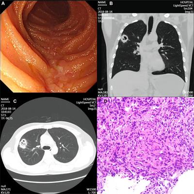 Case report: Confusing lung signs – is the source of the disease in the lungs or intestines?